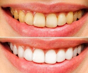 جرم گیری و سفید کردن دندان در خانه + آموزش