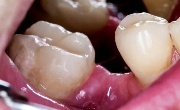 مشکلات مربوط به جای خالی دندان ها